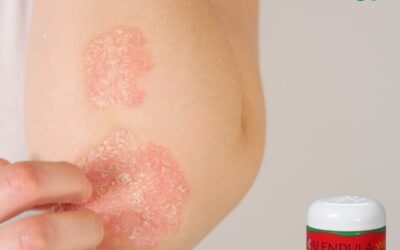 Psoriasis en la Piel